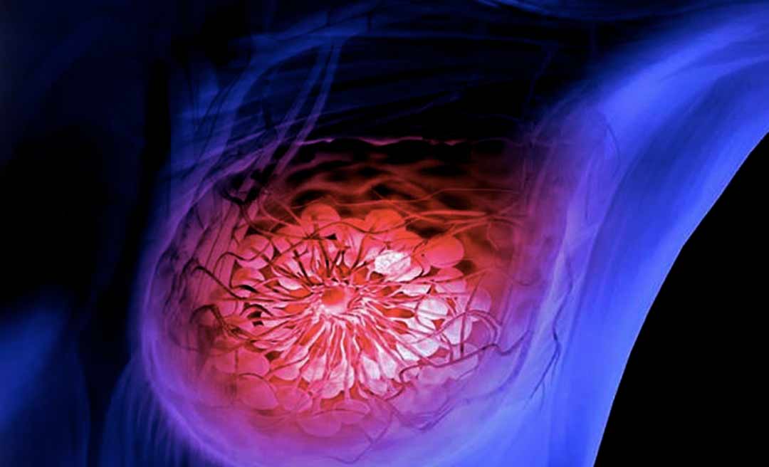 Acre tem estimativa para 80 novos casos de câncer de mama este ano, revela estudo do INCA