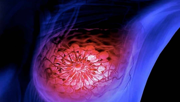 Acre tem estimativa para 80 novos casos de câncer de mama este ano, revela estudo do INCA