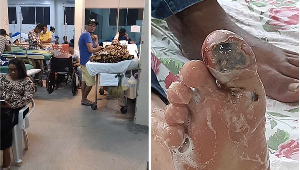 Paciente com dedo necrosado é internado “em pé” no Pronto Socorro