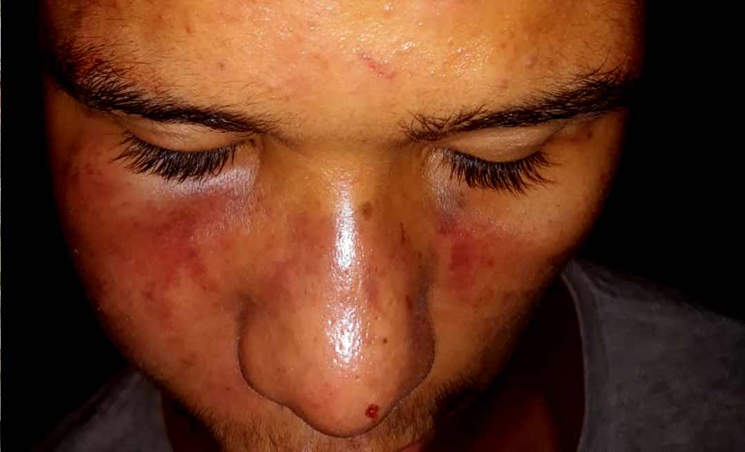 MPAC apura denúncia de agressão de PMs contra jovem em Plácido de Castro