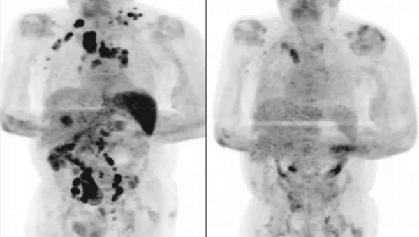 Após contrair Covid-19, homem tem redução de câncer em estágio avançado