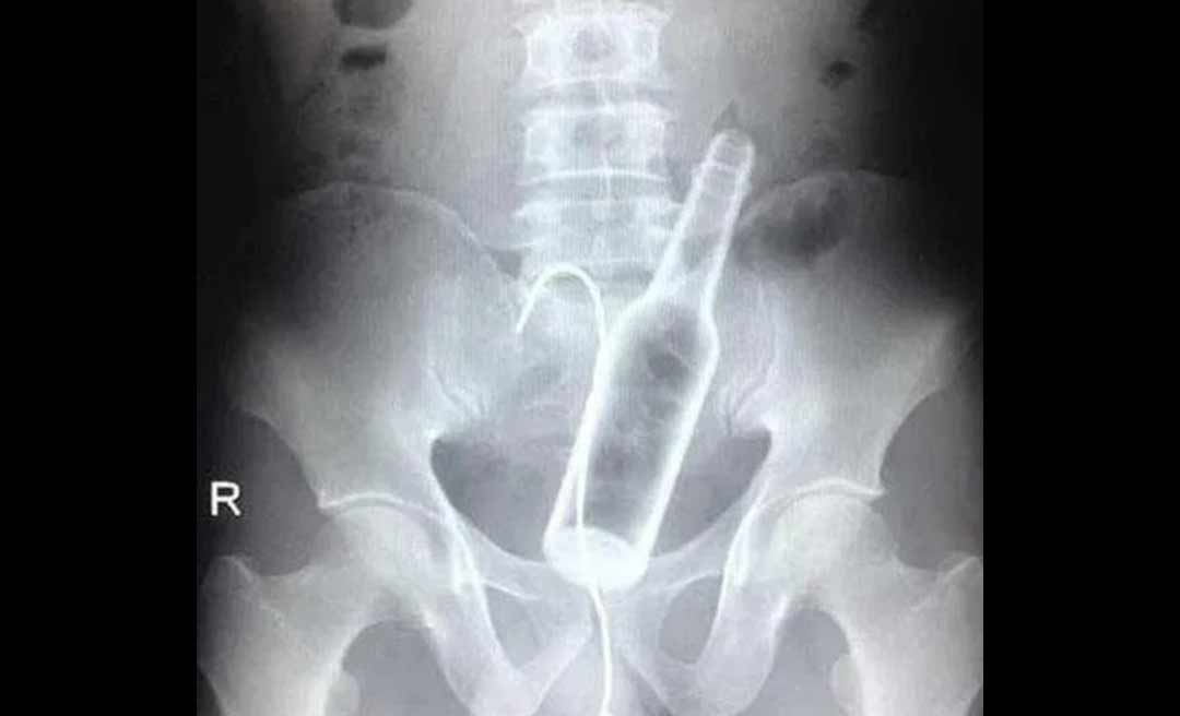 Após rodada de cerveja, jovem introduz garrafa no ânus e vai parar no PS de Rio Branco