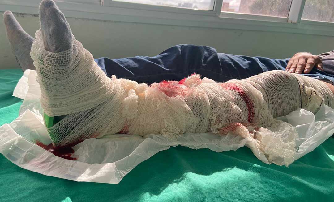 Paciente com fratura exposta aguarda mais de 5 horas por uma cirurgia no Pronto Socorro; “risco de infecção”, denunciam