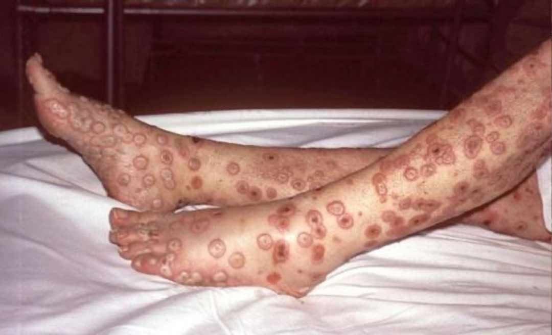 Saúde orienta sobre o que é, quais os sintomas e formas de prevenção da varíola do macaco