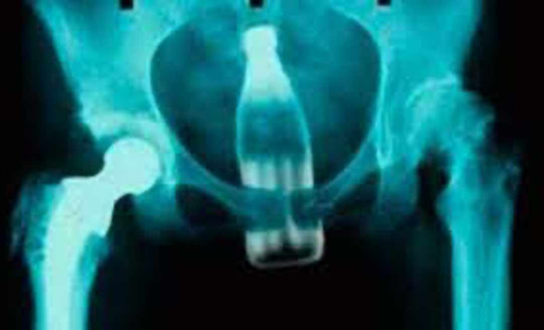 Na fronteira, homem introduz garrafa pet no ânus, fica mal e é transferido para Rio Branco às pressas