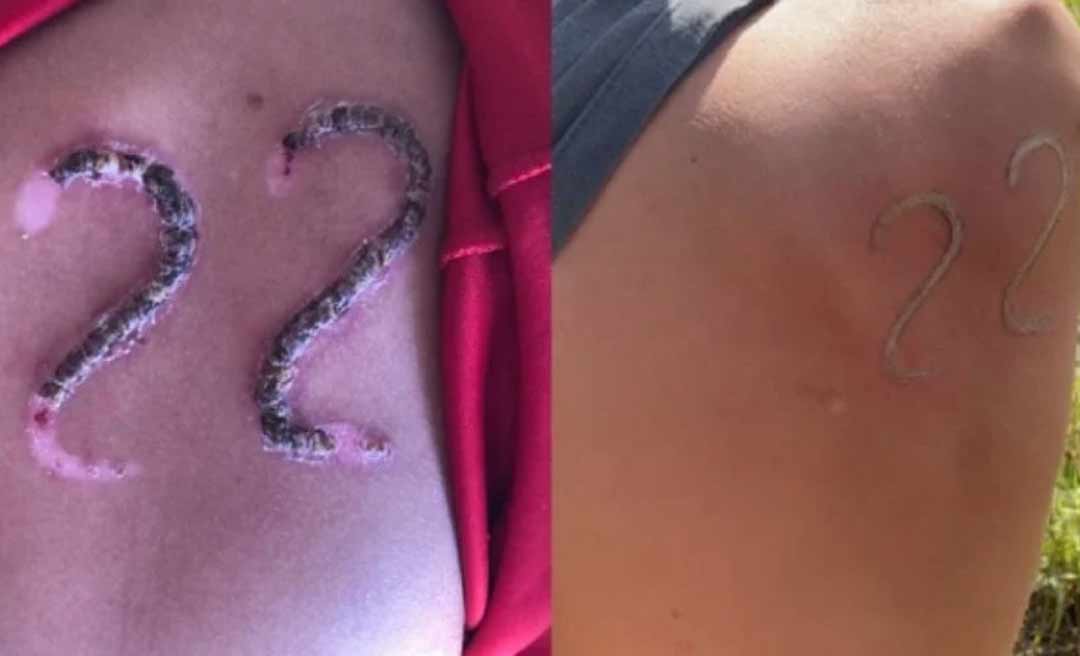 Jovem é desafiado e usa ferro em brasa para marcar 22 de Bolsonaro na pele