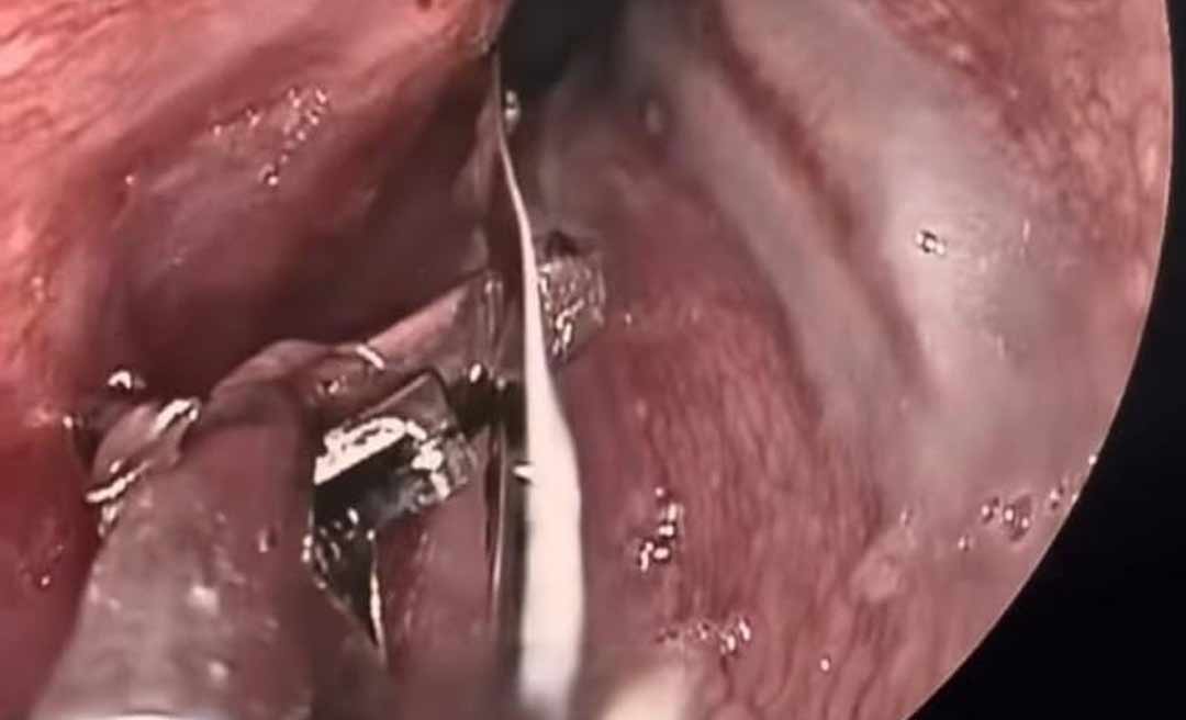 Detento de presídio no Acre é submetido a cirurgia após engolir lâmina de barbear