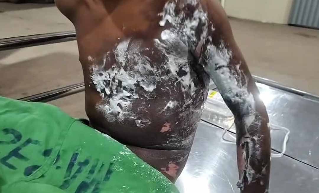 Criança indígena sofre queimaduras graves por choque elétrico e é transferida para Rio Branco