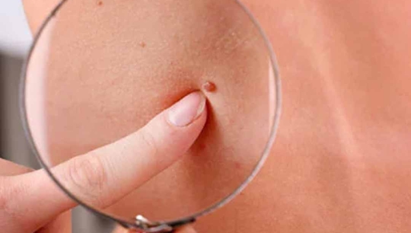 Câncer de pele atinge 16% mais mulheres no Brasil, diz o Instituto Nacional do Câncer