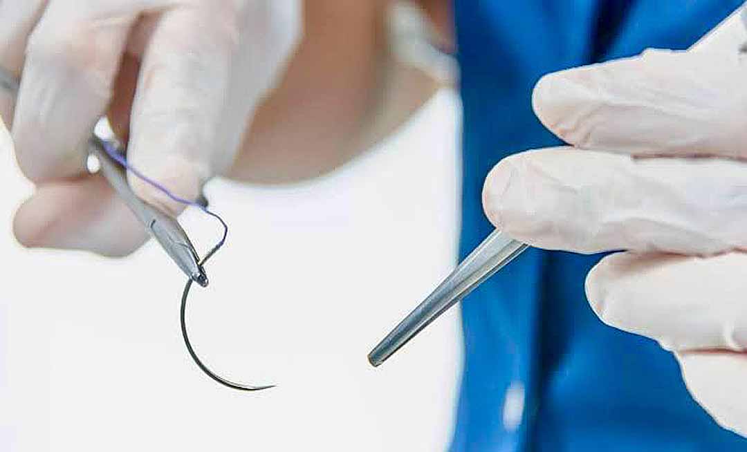 Após ação proposta pelo CRM, MPAC defende inconstitucionalidade de lei que autoriza sutura por enfermeiros