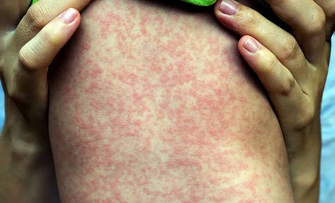 Após surto na Bolívia, Acre reforça vigilância e vacinação contra sarampo; 5 municípios são considerados prioritários