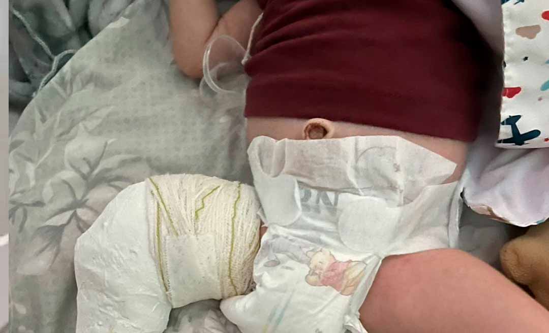 Campanha solidária busca doações para bebê Heitor, de apenas 1 mês, iniciar tratamento ortopédico