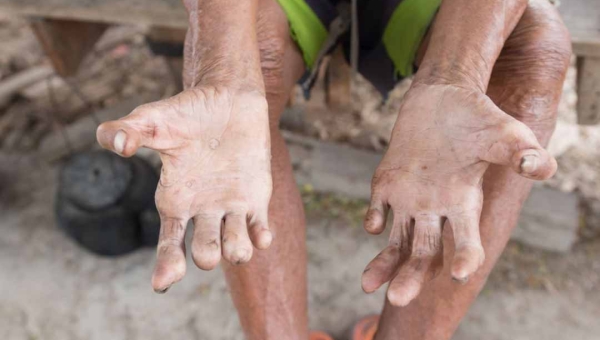 Hanseníase tem cura: campanha nacional reforça importância do diagnóstico precoce