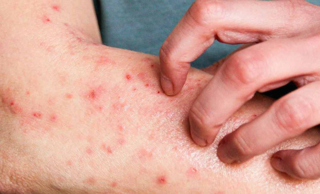 Prefeitura de Rio Branco investiga caso suspeito de mpox e reforça que não há motivo para pânico