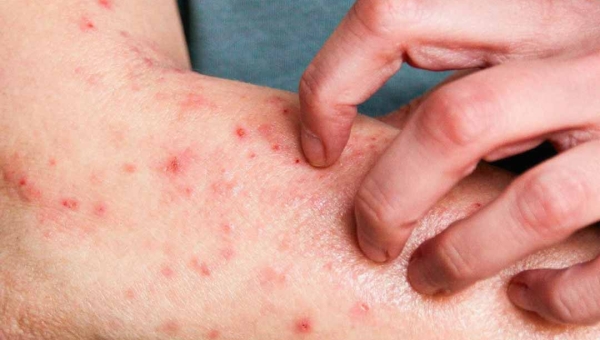 Prefeitura de Rio Branco investiga caso suspeito de mpox e reforça que não há motivo para pânico