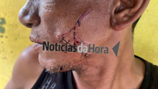 Homem sofre cortes profundos no rosto após ser atacado por mulher com garrafa em Manoel Urbano